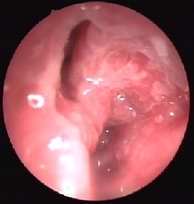 Orr papilloma septum. FESS műtét (Endoszkópos orrmelléküreg műtét) - Medicover